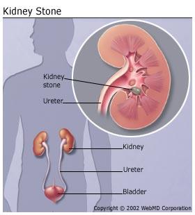 Stone in the Kidney
